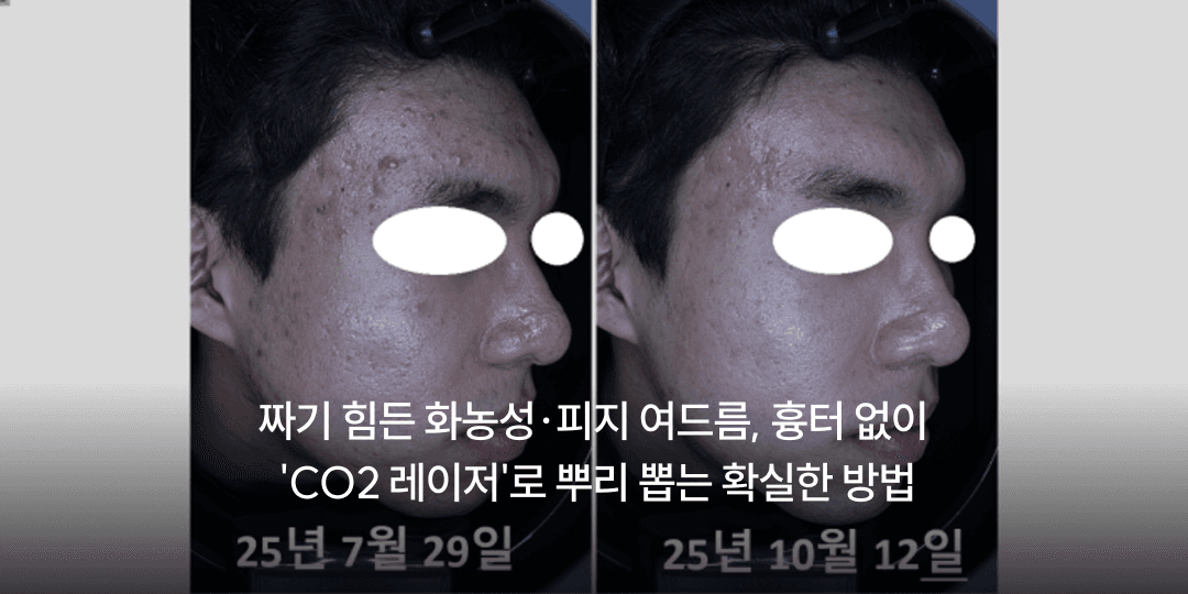 Pustular, sebum-packed acne: CO2 laser without scarring