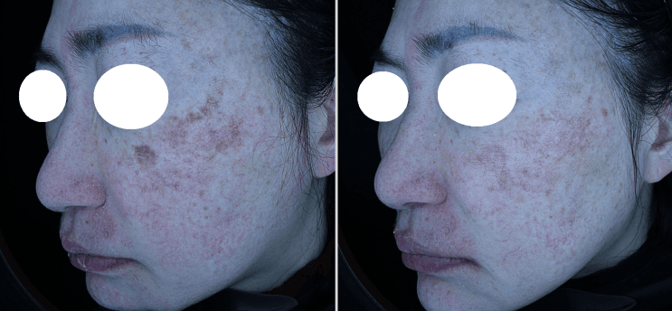 Treating stubborn melasma: consistency over flawless skin