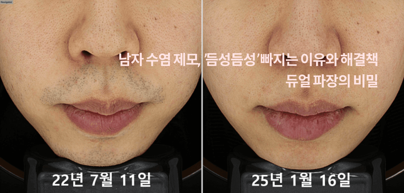 Men's beard removal: why hair clears patchily