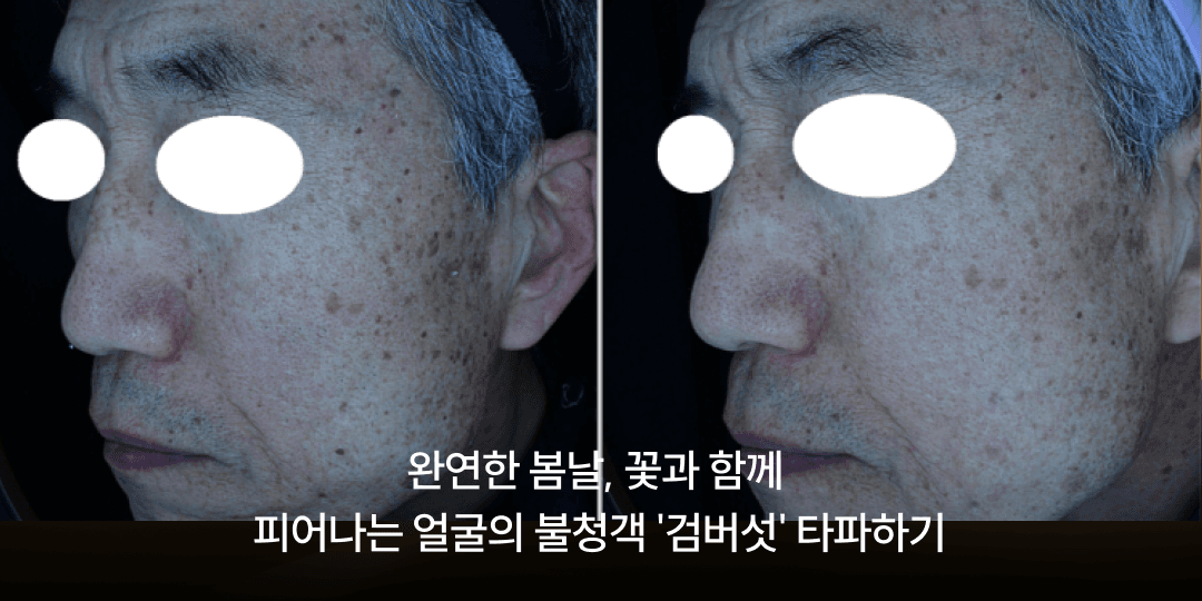 Age spots in spring: dealing with seborrheic keratosis