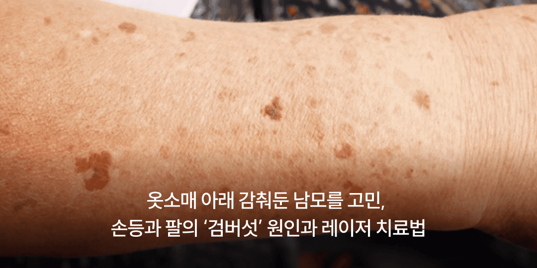 Age spots on the hands and arms: causes and laser treatment