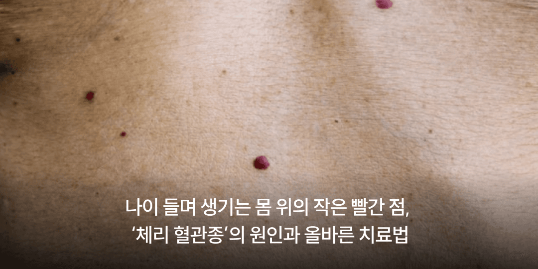 Small red dots on the body with age: cherry angioma explained