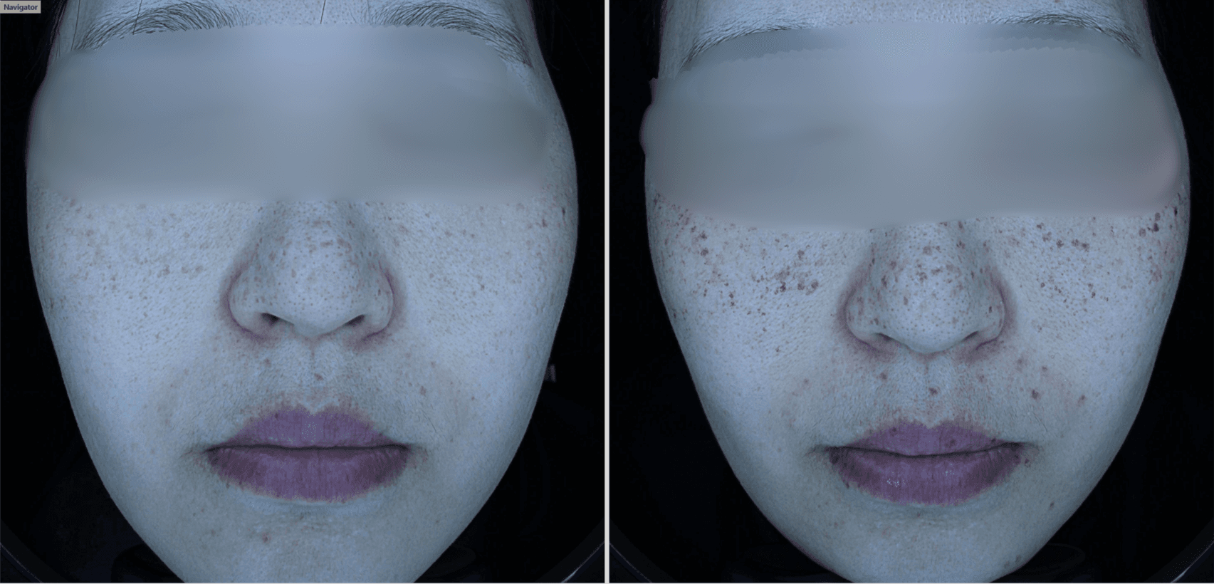 Freckles and epidermal pigment: the nBOM Lentigo Package