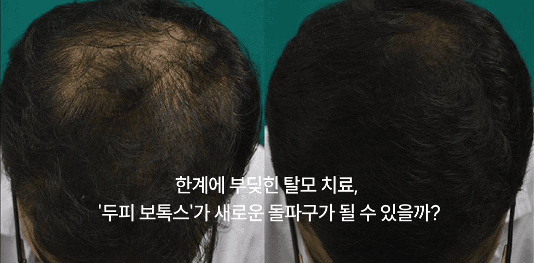 Could scalp botulinum toxin be a new route for hair loss treatment?