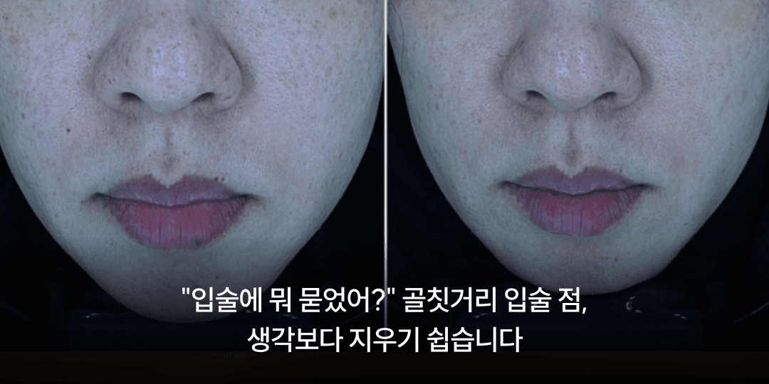 Lip spots are easier to remove than you think