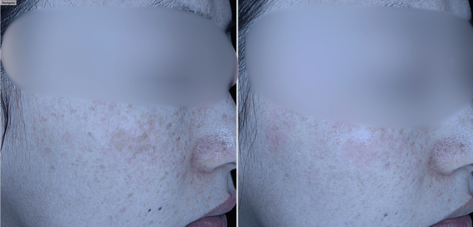 Sylfirm X: needle RF for refractory melasma
